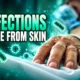spine surgery infections from patients own skin 86 percent